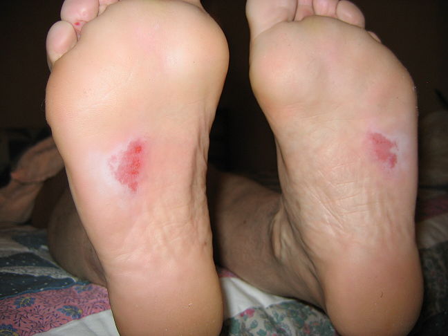 what does it mean if dark marks on sole of feet get darker and bigger